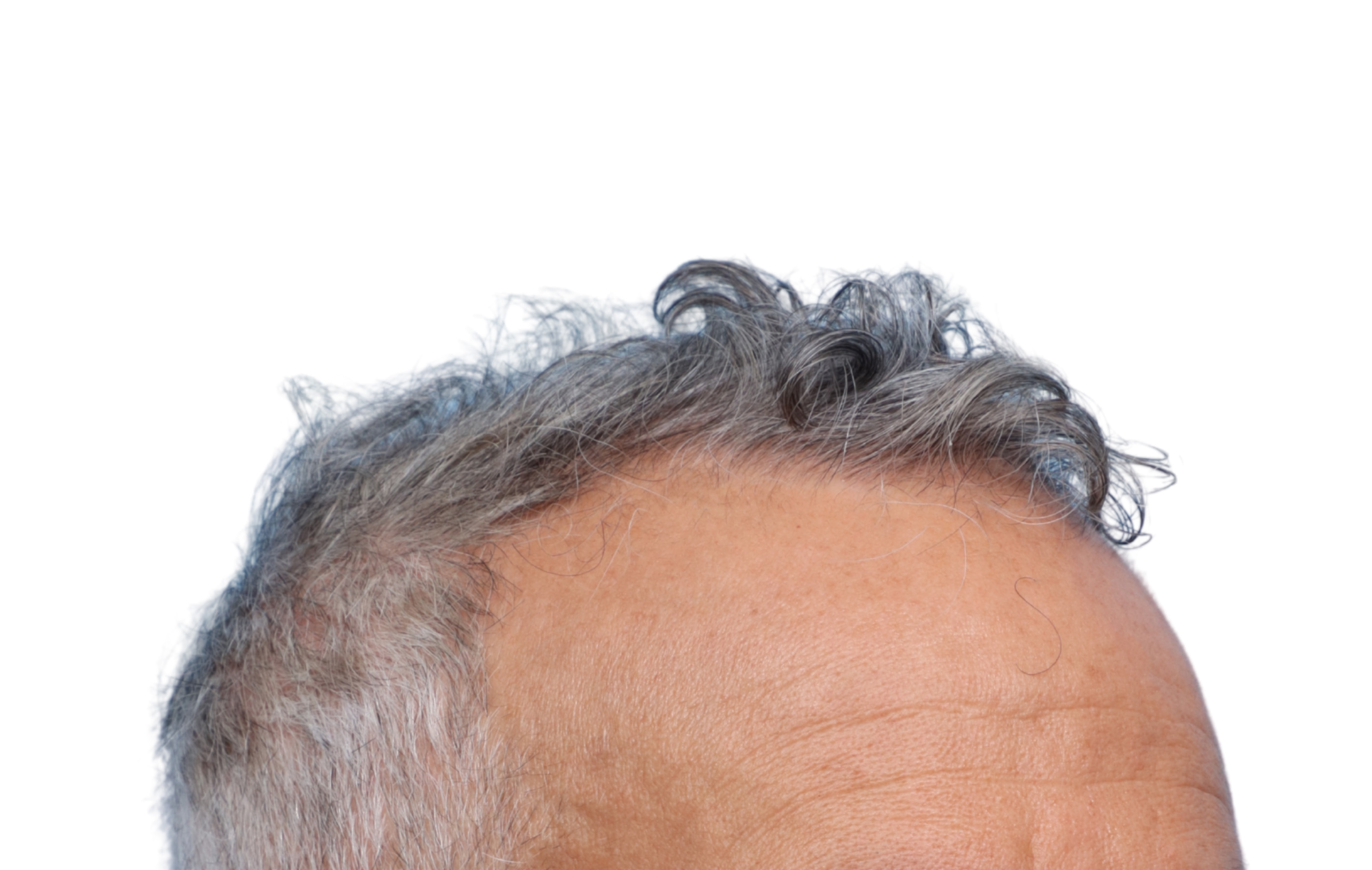 Fue Before and After | Dr. Jeffrey Wise