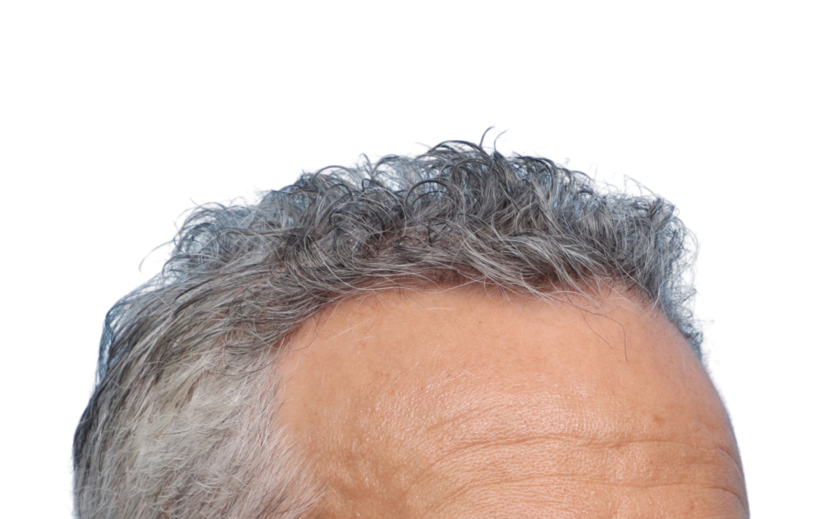 Fue Before and After | Dr. Jeffrey Wise