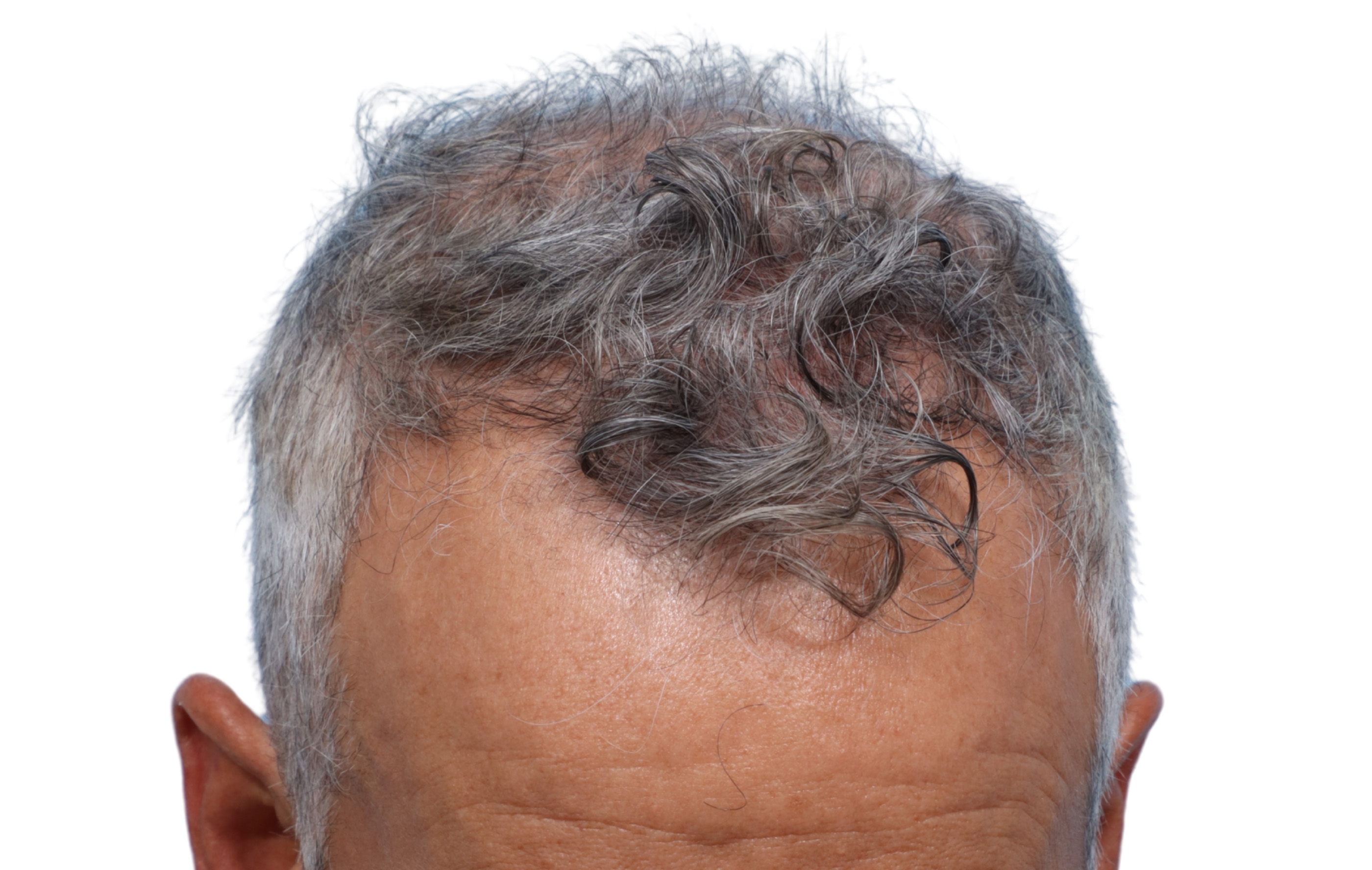 Fue Before and After | Dr. Jeffrey Wise