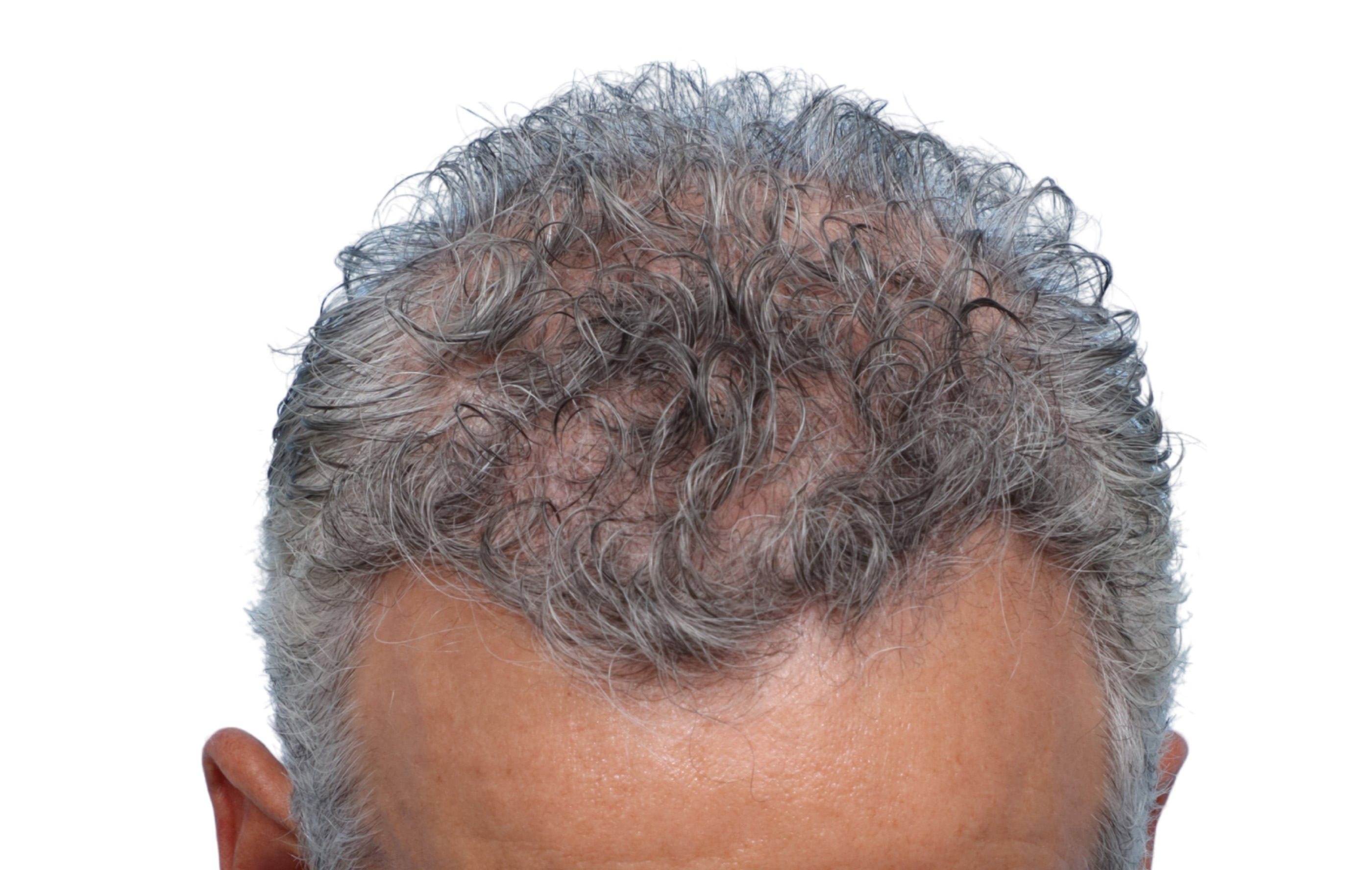 Fue Before and After | Dr. Jeffrey Wise