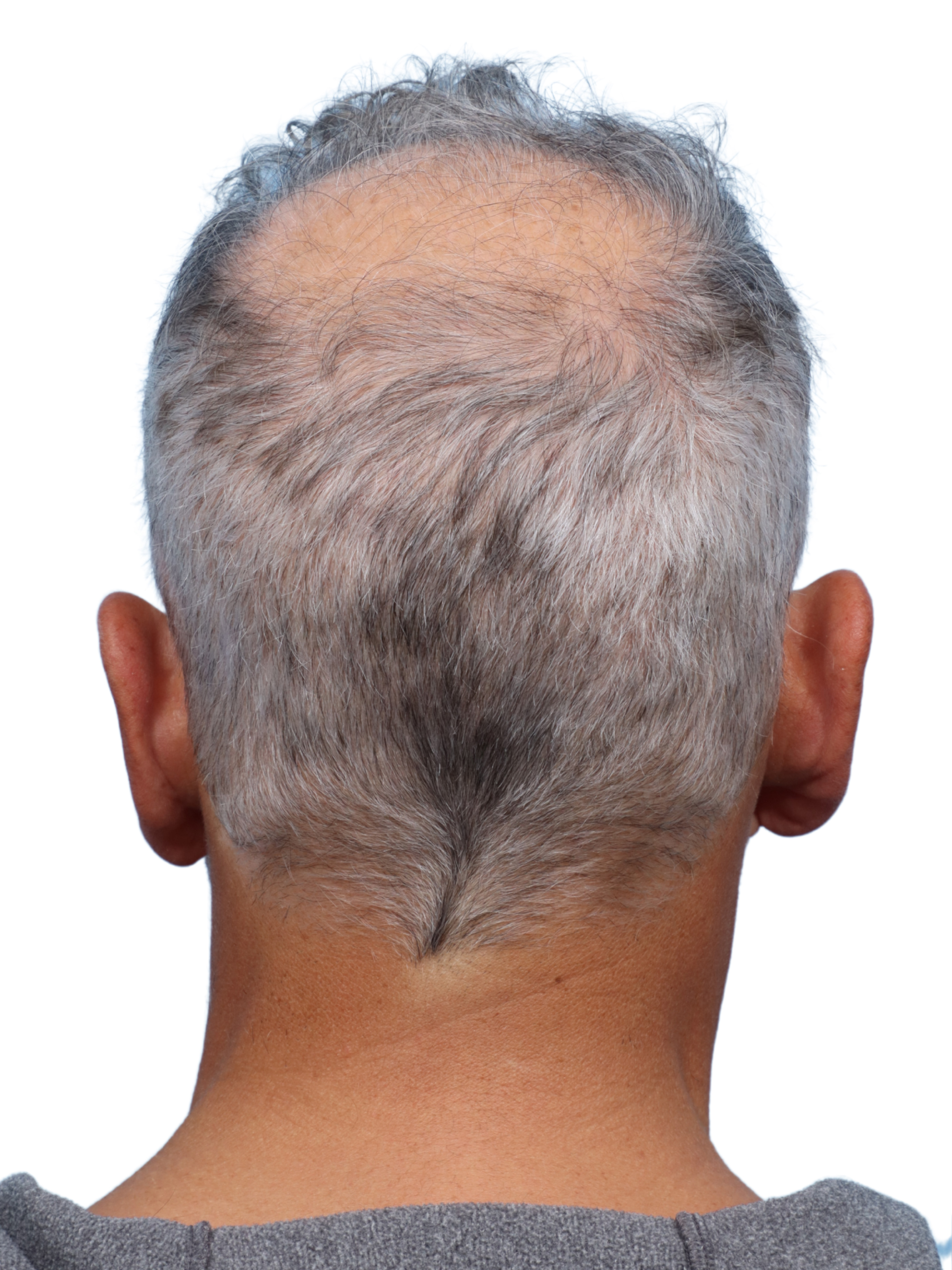 Fue Before and After | Dr. Jeffrey Wise