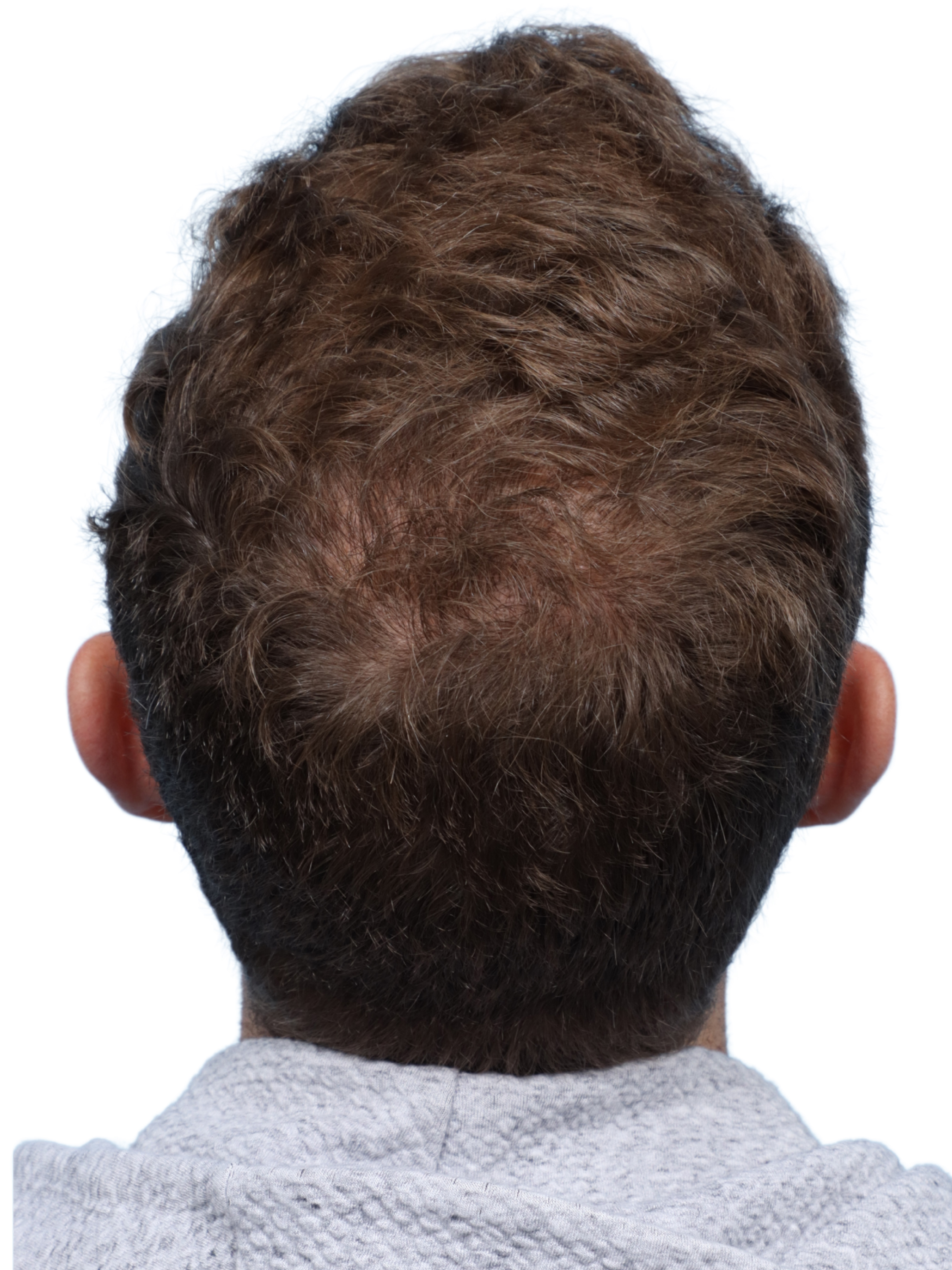 Fue Before and After | Dr. Jeffrey Wise