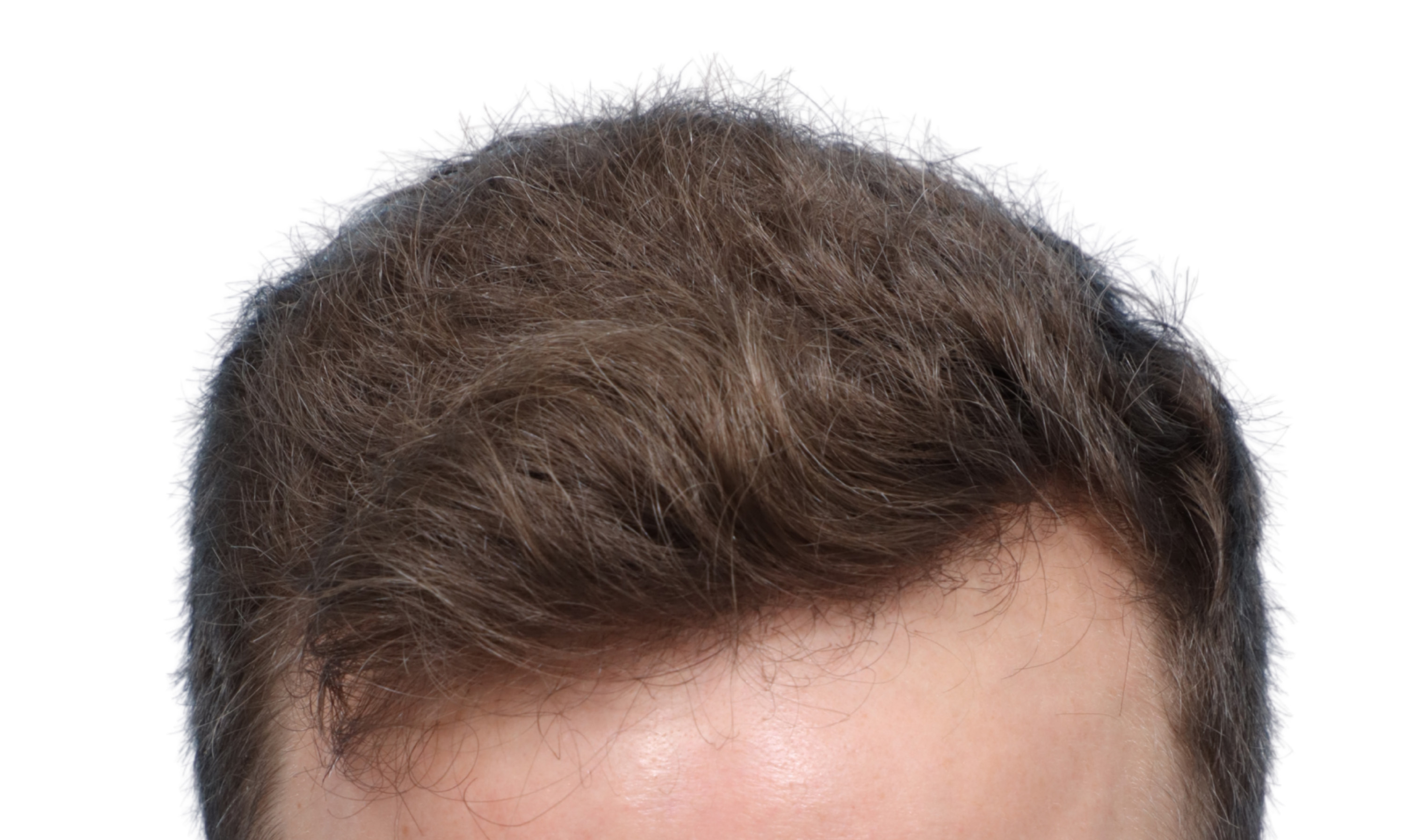 Fue Before and After | Dr. Jeffrey Wise