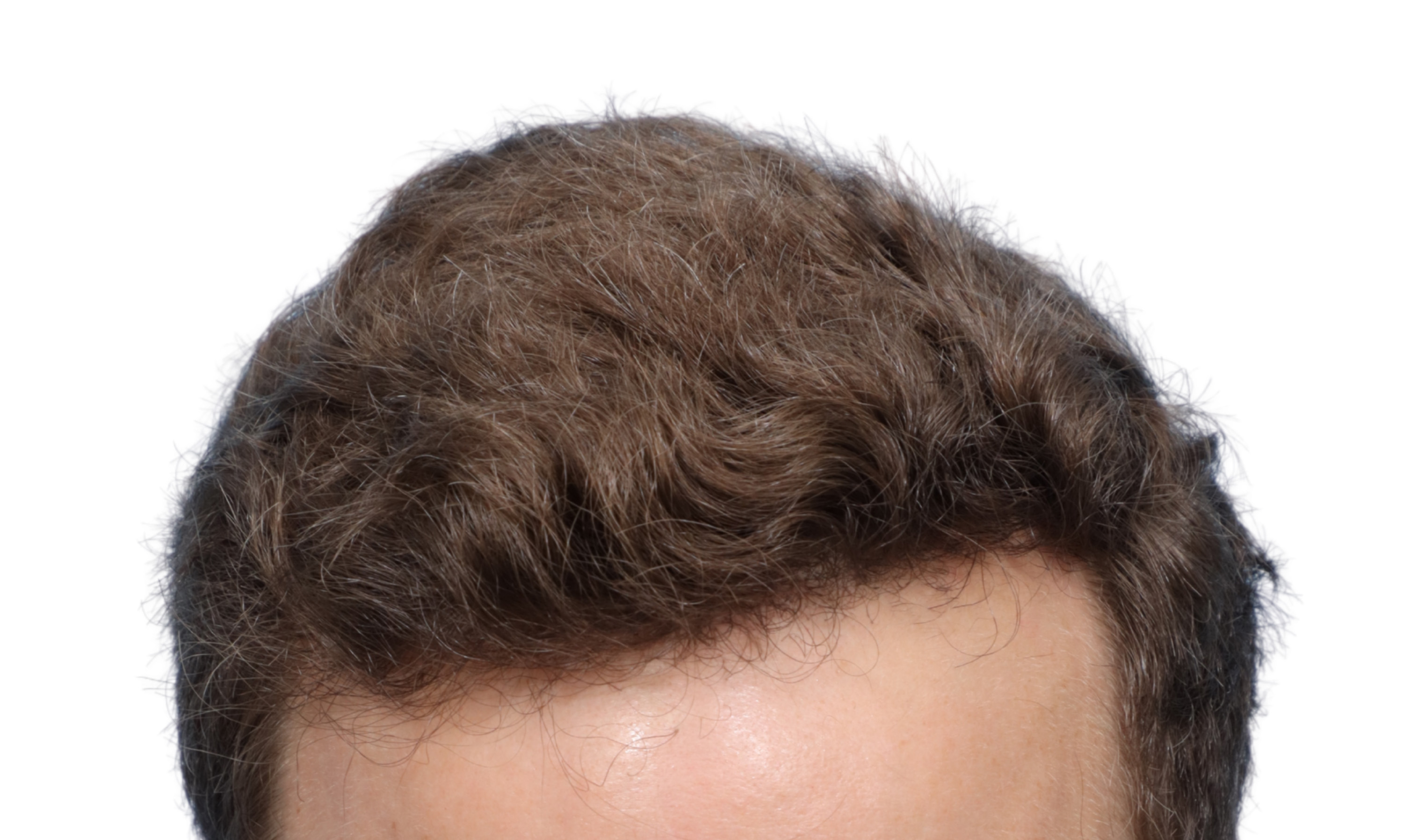 Fue Before and After | Dr. Jeffrey Wise