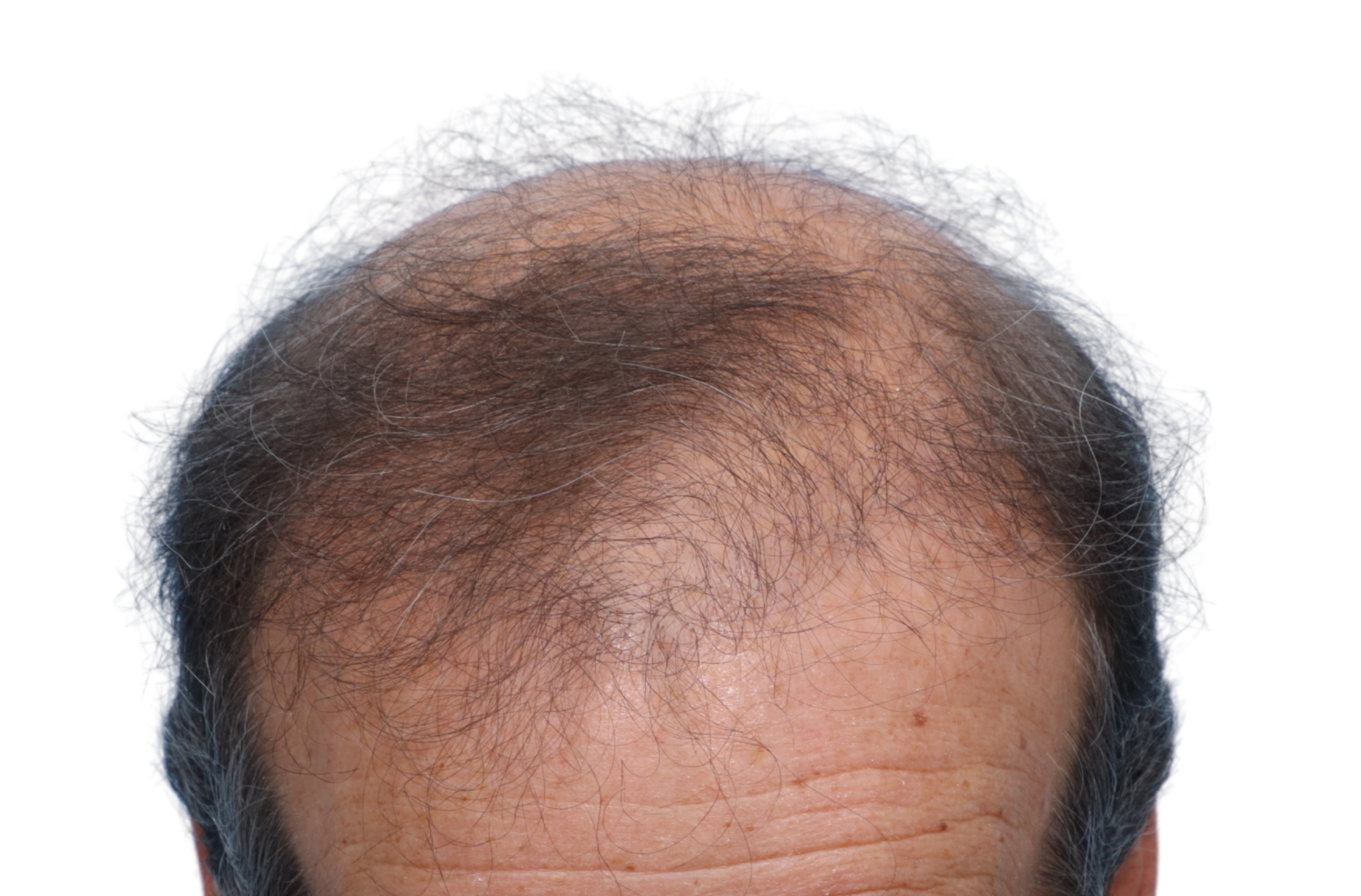 Fue Before and After | Dr. Jeffrey Wise