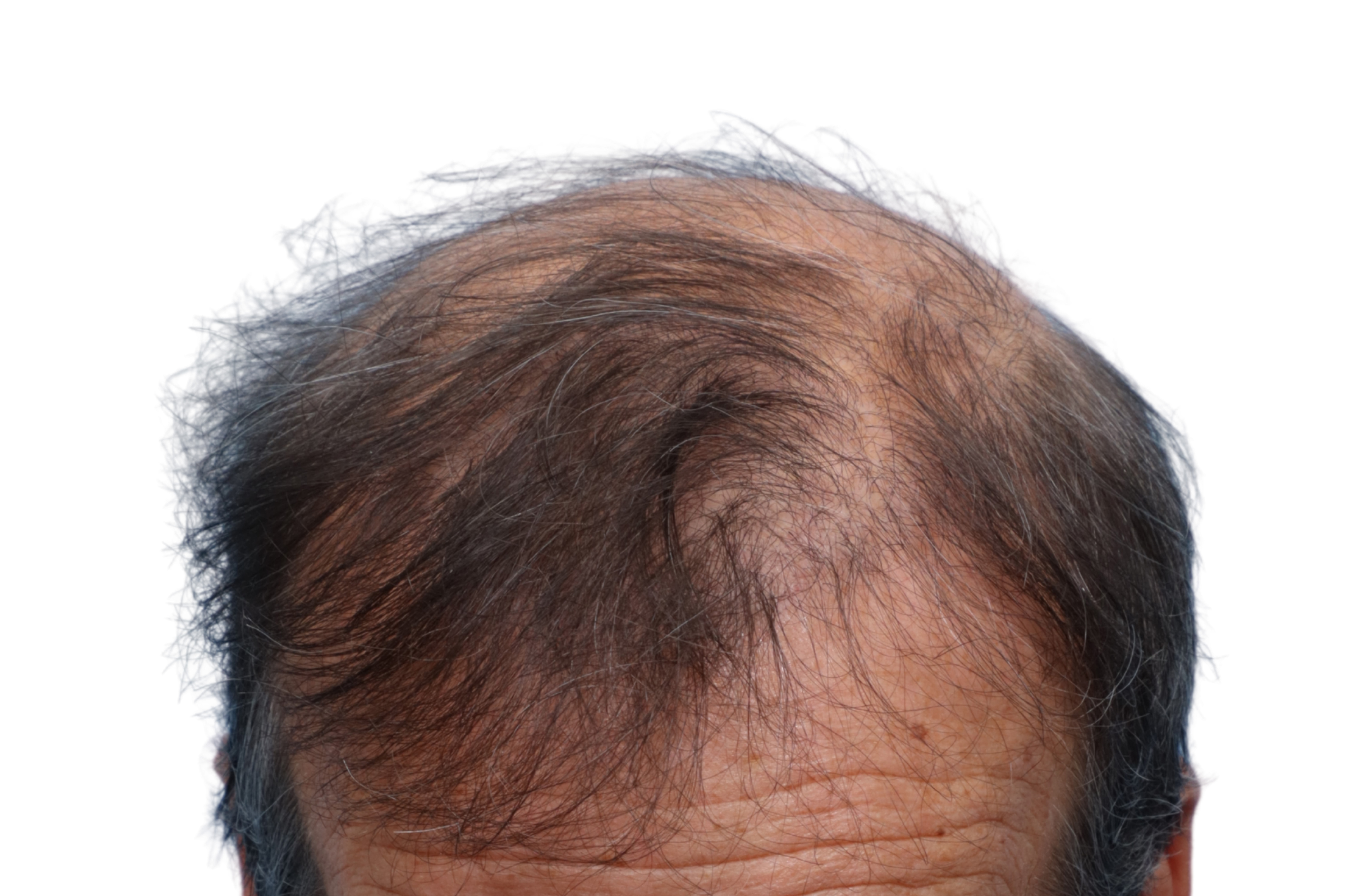 Fue Before and After | Dr. Jeffrey Wise
