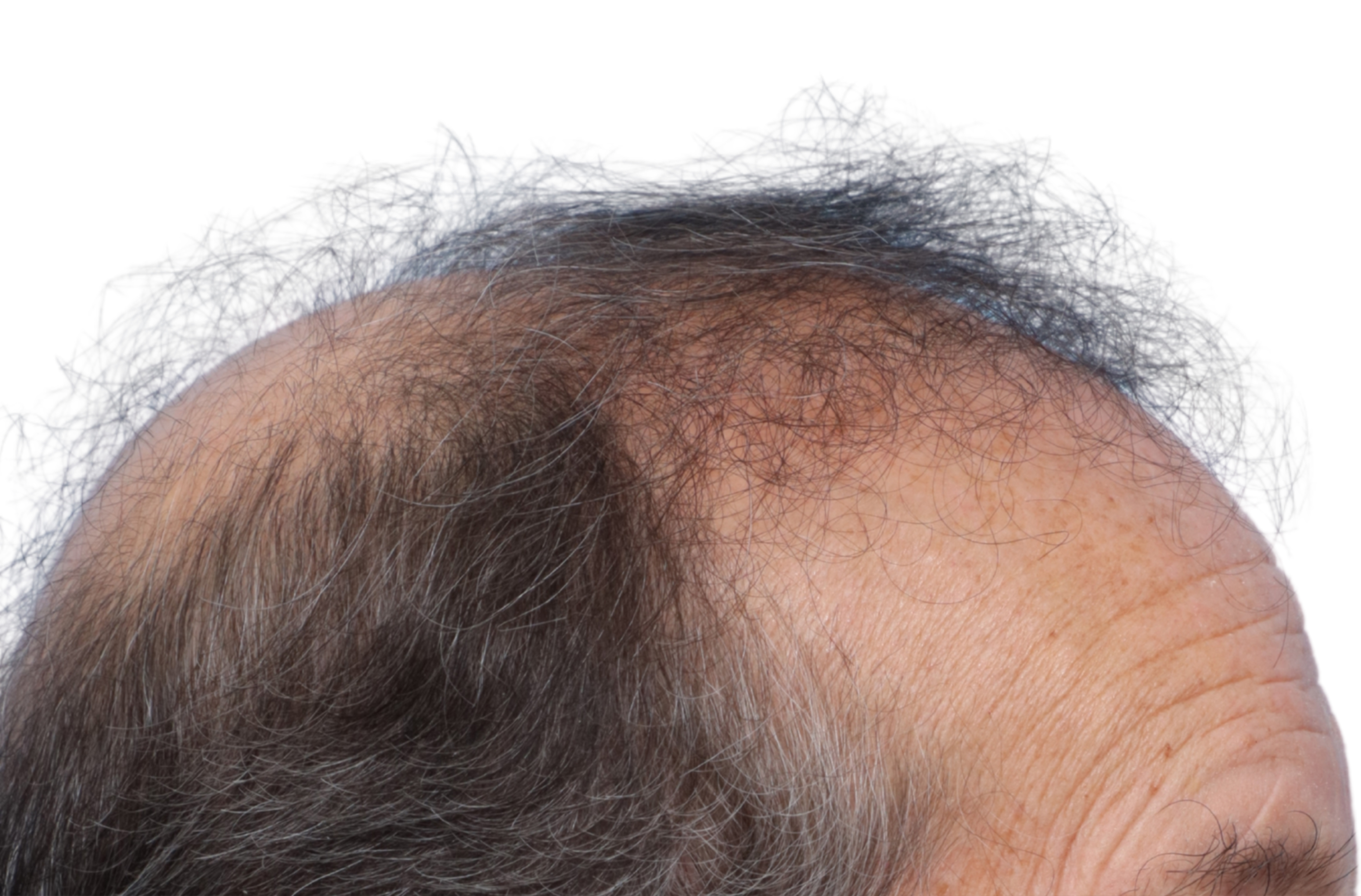 Fue Before and After | Dr. Jeffrey Wise