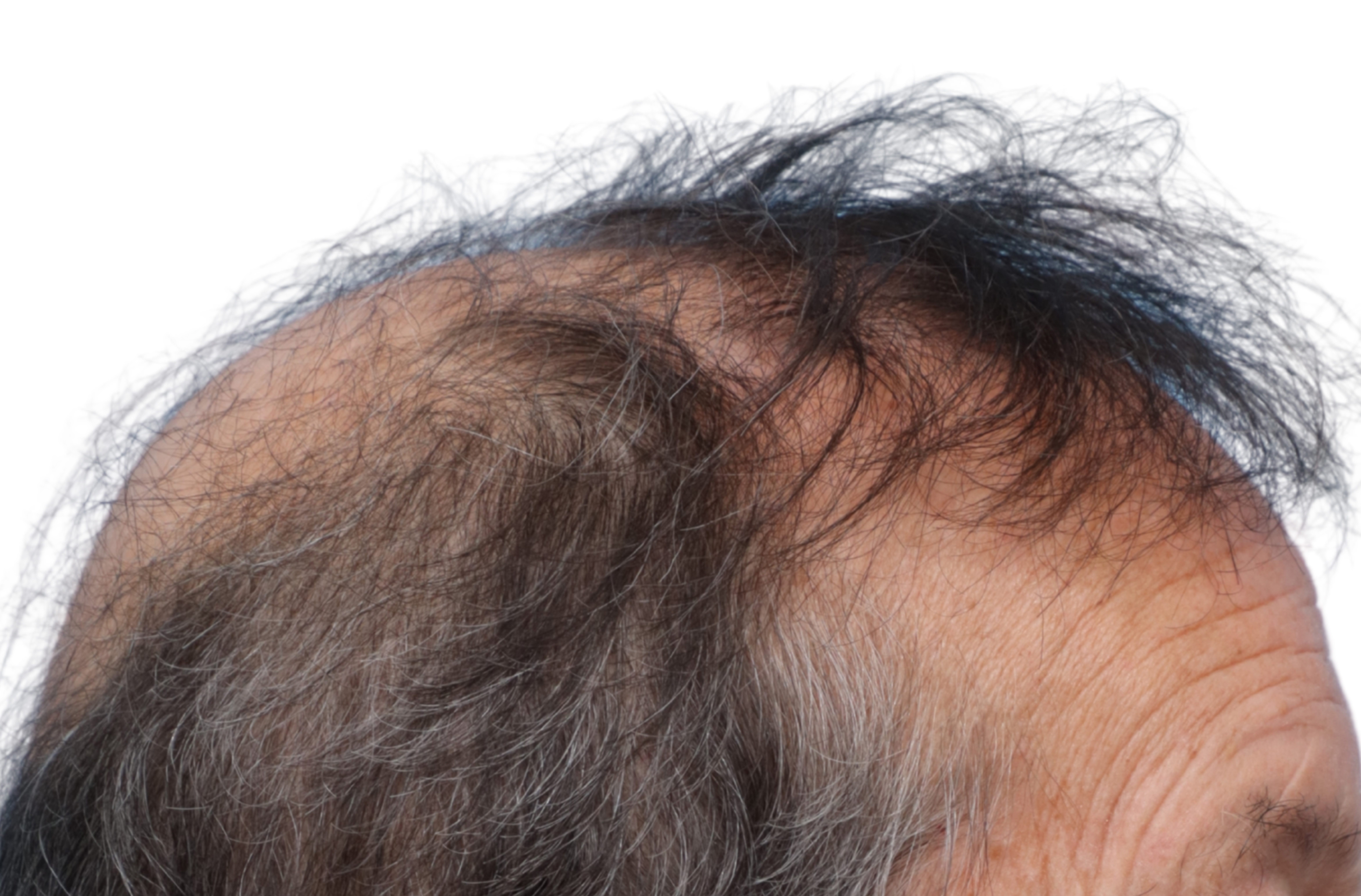 Fue Before and After | Dr. Jeffrey Wise