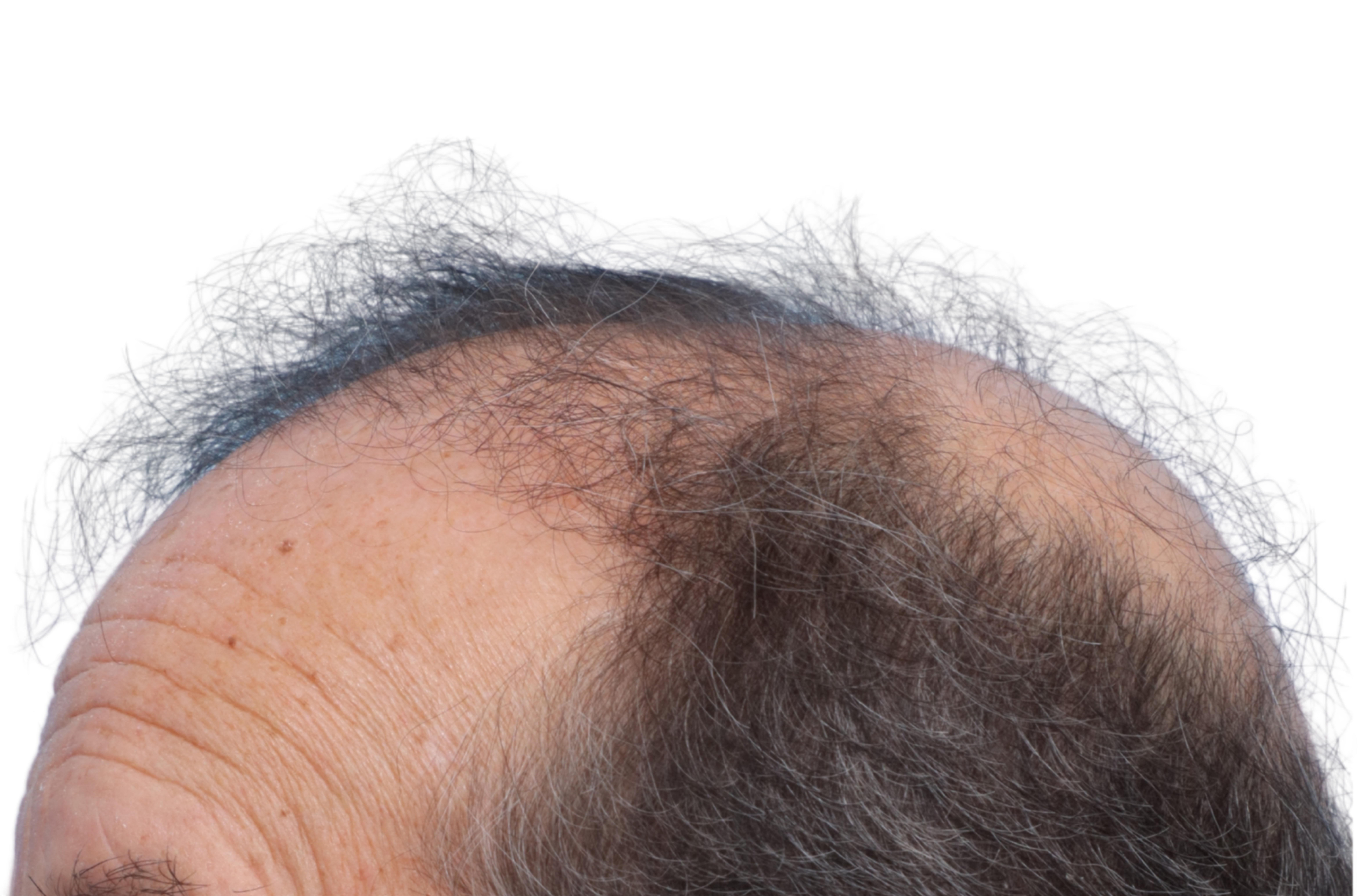 Fue Before and After | Dr. Jeffrey Wise
