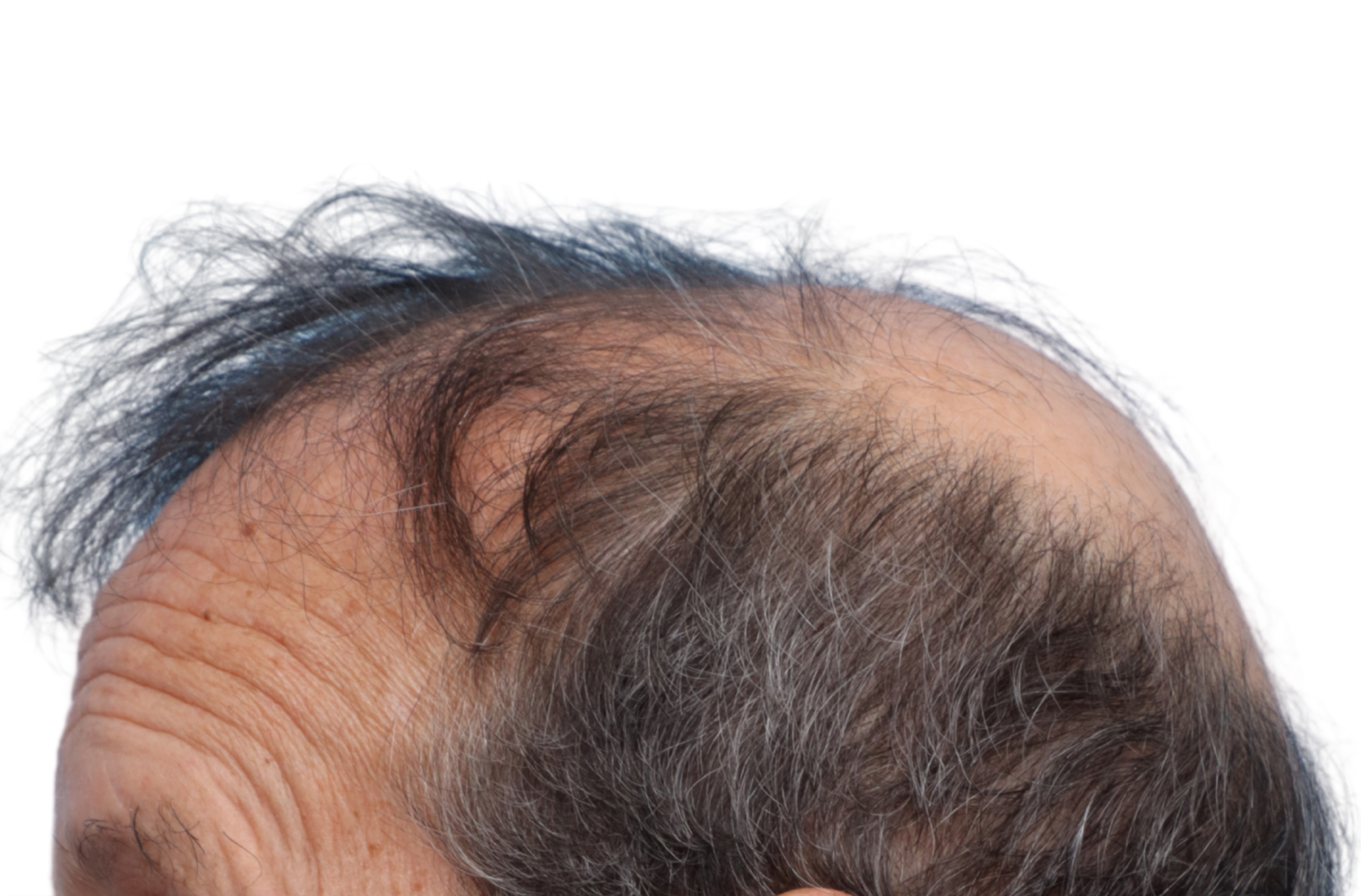Fue Before and After | Dr. Jeffrey Wise