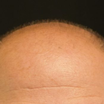 Fue Before and After | Dr. Jeffrey Wise