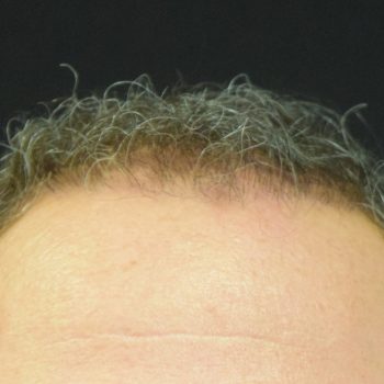 Fue Before and After | Dr. Jeffrey Wise