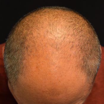 Fue Before and After | Dr. Jeffrey Wise