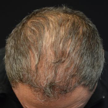 Fue Before and After | Dr. Jeffrey Wise