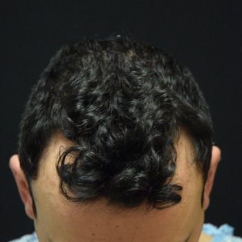 Fue Before and After | Dr. Jeffrey Wise