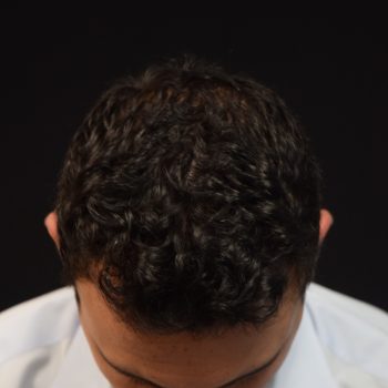 Fue Before and After | Dr. Jeffrey Wise