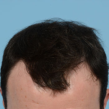 Fue Before and After | Dr. Jeffrey Wise