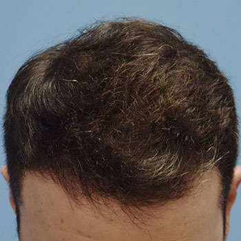 Fue Before and After | Dr. Jeffrey Wise