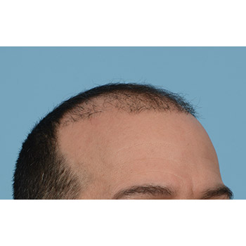 Fue Before and After | Dr. Jeffrey Wise