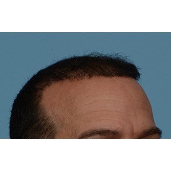 Fue Before and After | Dr. Jeffrey Wise