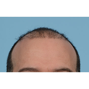 Fue Before and After | Dr. Jeffrey Wise