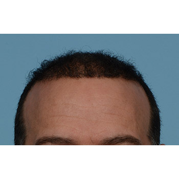 Fue Before and After | Dr. Jeffrey Wise