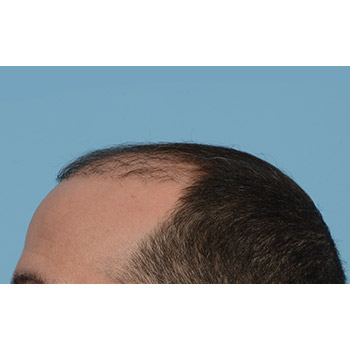 Fue Before and After | Dr. Jeffrey Wise