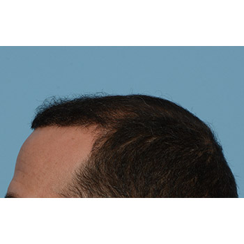 Fue Before and After | Dr. Jeffrey Wise