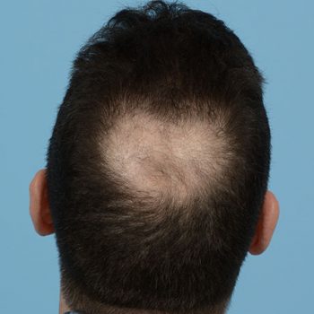 Fue Before and After | Dr. Jeffrey Wise