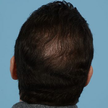 Fue Before and After | Dr. Jeffrey Wise