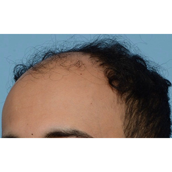 Fue Before and After | Dr. Jeffrey Wise