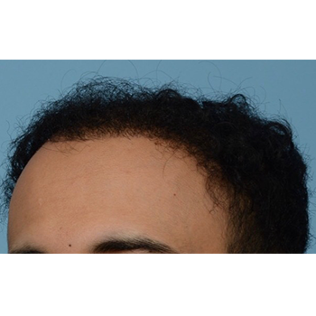 Fue Before and After | Dr. Jeffrey Wise