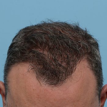 Fue Before and After | Dr. Jeffrey Wise