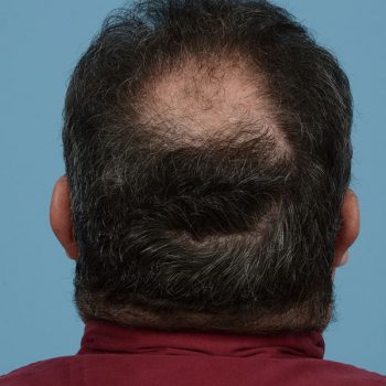 Fue Before and After | Dr. Jeffrey Wise