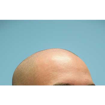 Fue Before and After | Dr. Jeffrey Wise