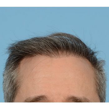 Fue Before and After | Dr. Jeffrey Wise