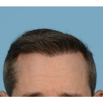 Fue Before and After | Dr. Jeffrey Wise