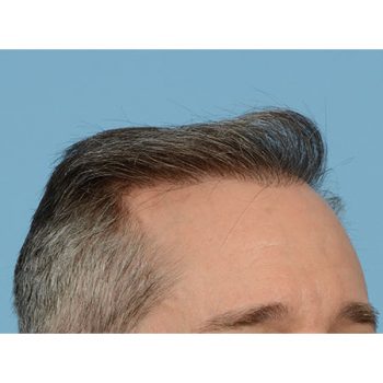 Fue Before and After | Dr. Jeffrey Wise