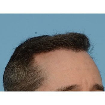 Fue Before and After | Dr. Jeffrey Wise