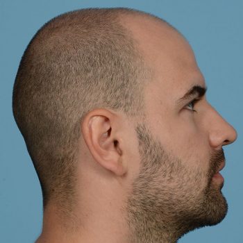 Fue Before and After | Dr. Jeffrey Wise