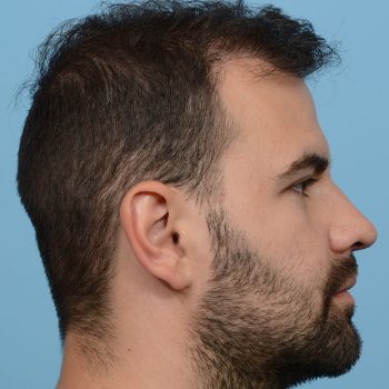 Fue Before and After | Dr. Jeffrey Wise