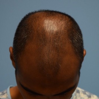 Fue Before and After | Dr. Jeffrey Wise