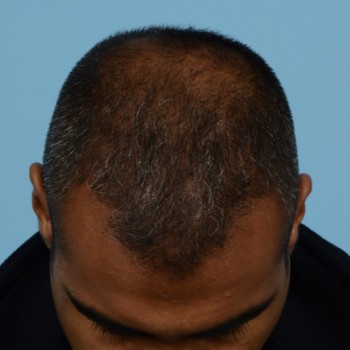 Fue Before and After | Dr. Jeffrey Wise