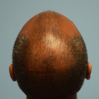 Fue Before and After | Dr. Jeffrey Wise