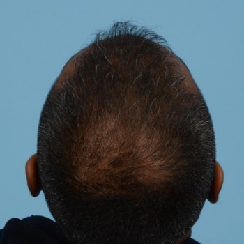 Fue Before and After | Dr. Jeffrey Wise