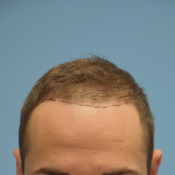 Fue Before and After | Dr. Jeffrey Wise