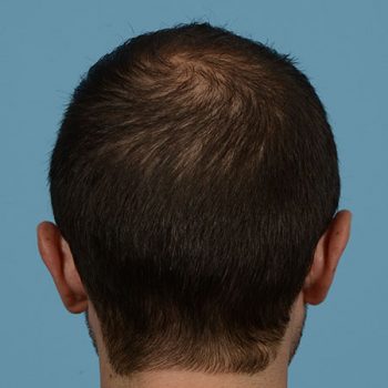 Fue Before and After | Dr. Jeffrey Wise