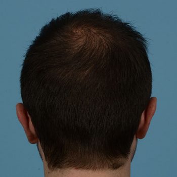 Fue Before and After | Dr. Jeffrey Wise