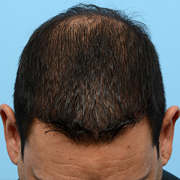 Fue Before and After | Dr. Jeffrey Wise