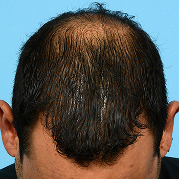 Fue Before and After | Dr. Jeffrey Wise